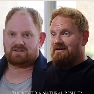 One of the biggest misconceptions about hair transplantation is that a perfect hairline creates the 