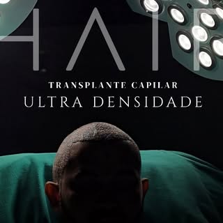 Reconstrução completa de região frontal em paciente jovem, com altíssima densidade e naturalidade!