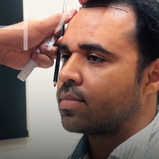 O grande desafio de operar pacientes jovens é projetar o futuro. 📐✨
​Redesenhar a linha frontal nes