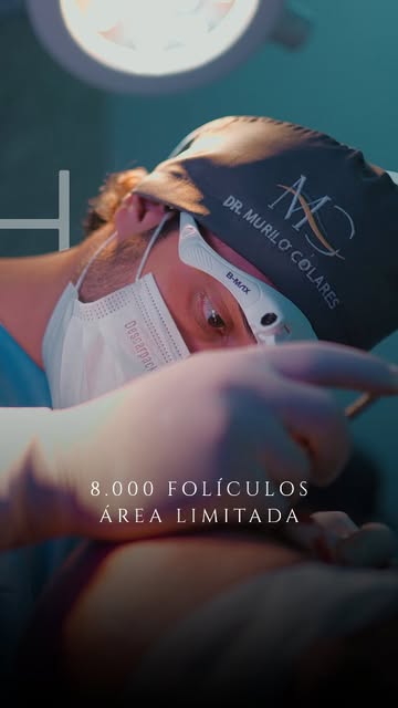 Superando limites na restauração capilar! 🚀

​📌 Especificidades do caso:
• Calvície avançada (Grau