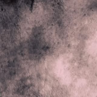 Podemos apreciar una despigmentación en escote  debido a varios carcinomas. Resultados muy naturales