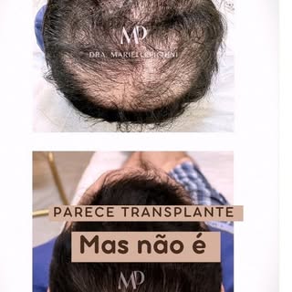Descubra nosso protocolo avançado para calvície e veja este resultado impressionante após apenas 2 m