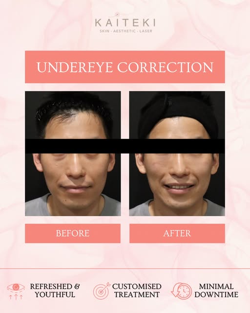 𝐓𝐢𝐫𝐞𝐝 𝐨𝐟 𝐥𝐨𝐨𝐤𝐢𝐧𝐠 𝐭𝐢𝐫𝐞𝐝? 🐼 

🤔 Sometimes your “dark circles” aren’t really dark 