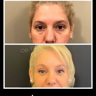 4-LID Blepharoplasty surgery, endoscopic muscle lifting, and facial fat injection

Sharing permissio