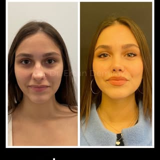 Do you have any questions about Rhinoplasty? If you want to get detailed information about the treat
