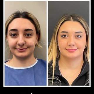 Do you have any questions about Rhinoplasty? If you want to get detailed information about the treat