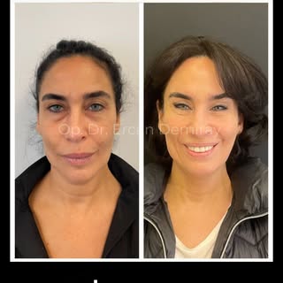 4-LID Blepharoplasty surgery, endoscopic muscle lifting

Sharing permission granted

Surgery date: 0