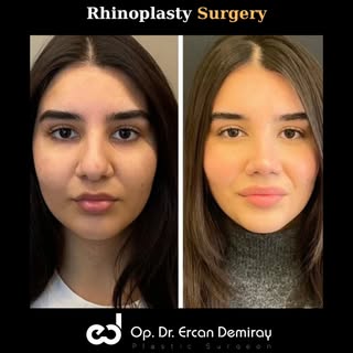 Do you have any questions about Rhinoplasty? If you want to get detailed information about the treat