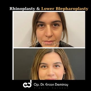 Performed Procedures: Rhinoplasty&Lower Blepharoplasty 

 If you want to get detailed information ab
