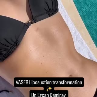 VASER Liposuction transformation ✨A closer look at the results achieved with Stomach & Waist VASER L