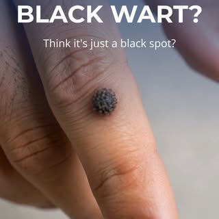 Think that black spot is just a wart? Think again.

A black wart is a common skin condition caused b