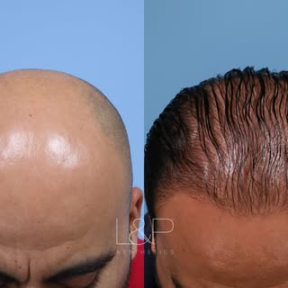Who says hair loss is irreversible? We’re proving them wrong with remarkable results!

In honor of H