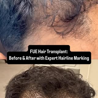 Before & After Hair Transplant: The Role of Precise Hairline Marking in FUE

Hairline design is a fo