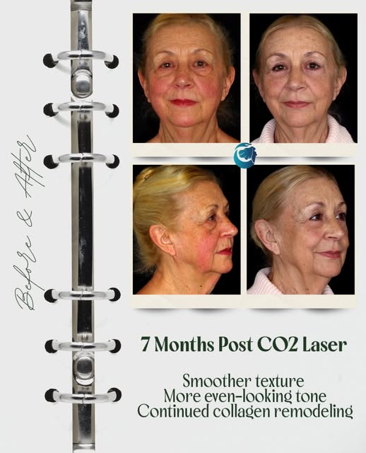 Seven months later, and the results are still developing.
💙
CO2 laser resurfacing supports continue