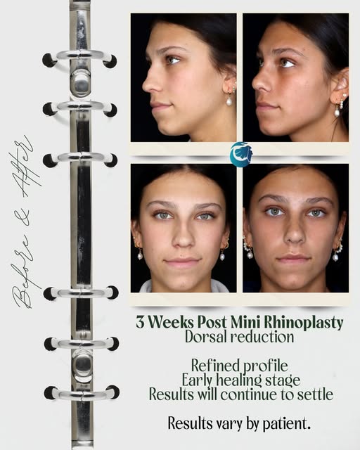 3 weeks post mini rhinoplasty with dorsal reduction.👃

Even this early in the healing process, you 