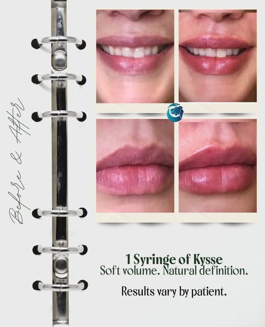 Sometimes one syringe is all it takes.💉

1 syringe of Restylane Kysse added soft volume and definit