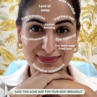 Your breakouts may have patterns but an acne map is only a guide, not a medical diagnosis. 🔍

Hair 