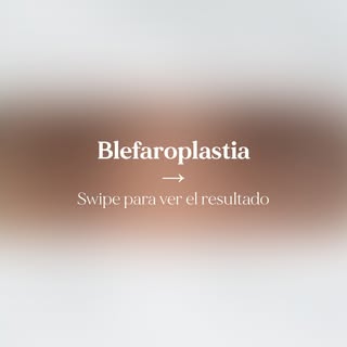 ¿Sabías que la blefaroplastia es un procedimiento ambulatorio? 👁️ Pero más allá de rejuvenecer la m