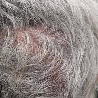 Acompanhem esse resultado incrível após MMP’s! 

#mmp #alopecia #calvicie #alopeciauniversalis