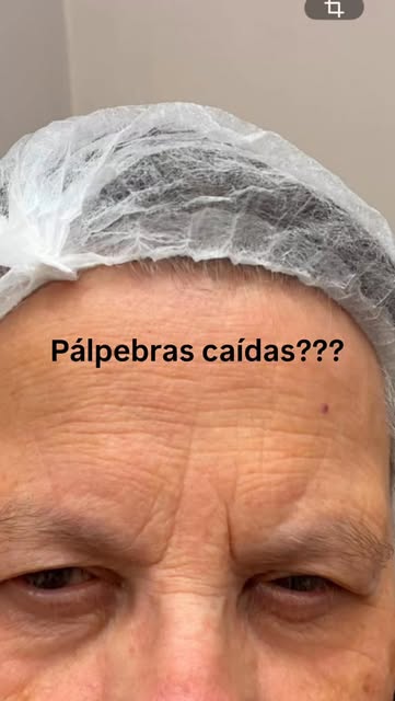 E suas pálpebras, como estão? 🫪😍🤨#dermatologia #cirurgiadermatologica #palpebras #blefaroplastia