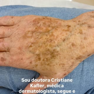 #pintas #dermatologia #peeling