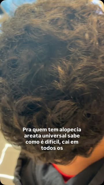 Que resultado!!!!!! #dermatologia #alopecia