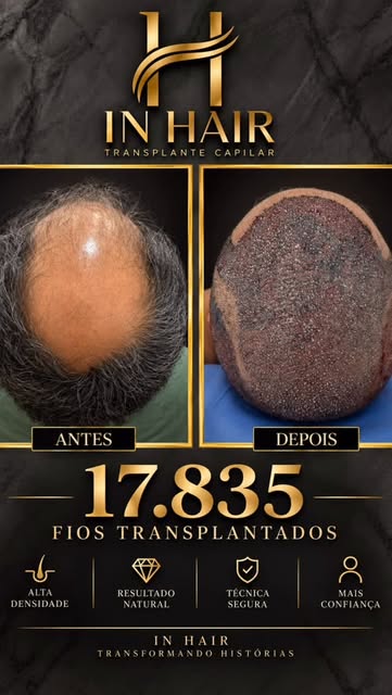 Mais um caso extraordinário! Uma Giga Sessão maravilhosa . Parabéns a nosso querido paciente. InHair