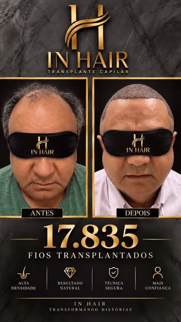 Mais um caso extraordinário! Uma Giga Sessão maravilhosa . Parabéns a nosso querido paciente. InHair