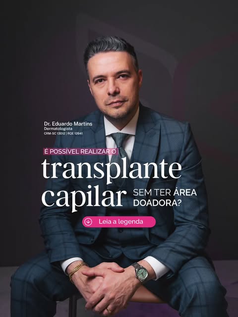 O transplante capilar depende de folículos saudáveis para preencher as regiões com perda de cabelo. 