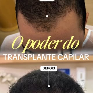 Um rosto mais jovem e uma hairline natural!
Por aqui não existe aquele papo de “cabelo de boneca”.
C