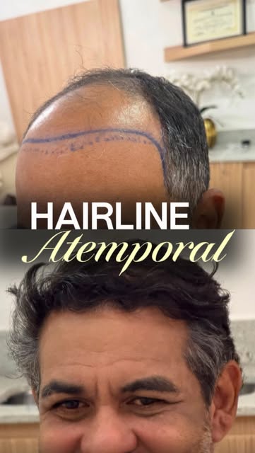 Hairline bonita não é aquela que segue uma tendência. É aquela que combina com você hoje e continua 