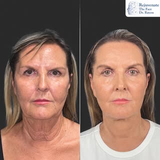7 months postop Before and after: facelift, necklift, and browlift.

You can see a cleaner jawline a