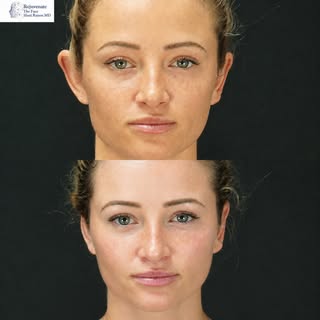 This patient had an ear setback surgery to reduce her prominent ears.

Otoplasty, also called an ear