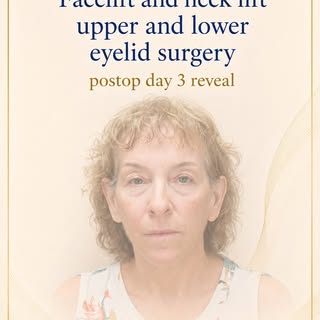 Post op day 3 after facial rejuvenation.

Procedures performed:
• Facelift
• Necklift
• Upper eyelid