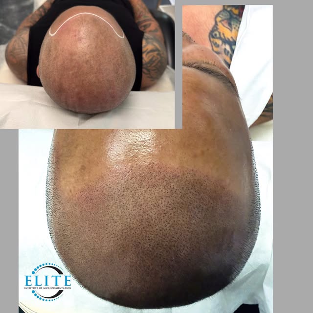 HAIR LOSS? THERE’S A NATURAL-LOOKING SOLUTION. 

Scalp Micropigmentation (SMP) can create the appear