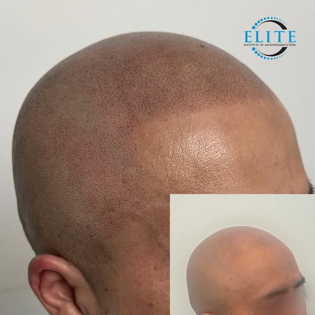 Hair loss can affect more than your appearance—it can affect how you feel about yourself.
Scalp Micr