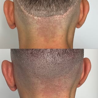 FUT & FUE scar camouflage with Scalp Micropigmentation

Scars will never be 100% camouflaged. 80-90%