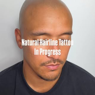 Frame your face naturally with SMP hairline tattoo. Redness will reduce in 24h and impressions will 