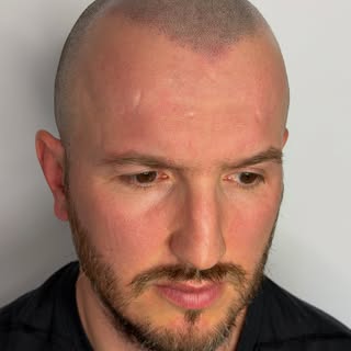 Hairline density work in progress ⏳

Two sessions done, one to go

Redness will disappear in a few h
