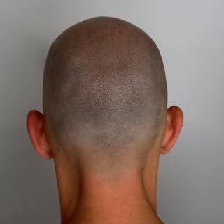 The crown is one of the biggest giveaways of hair loss.

With the right density, placement, and grad