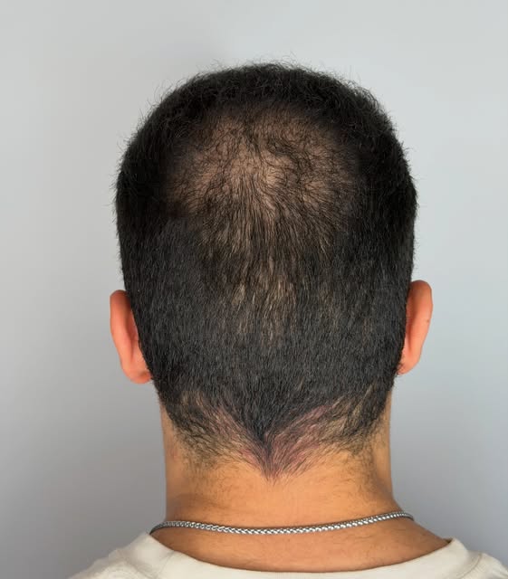 Density SMP done properly 👏

It’s not about making the scalp completely dark or packing in as much 