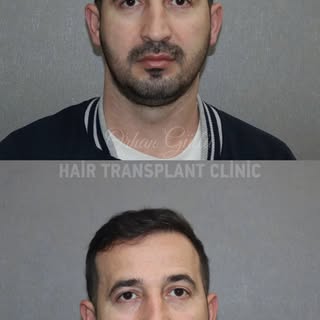 İlləri geri qaytarmaq mümkündür? Bizimlə: Bəli! 🔥

Saç tökülməsi həyat tərzinizi dəyişdirməsin.
Dr.