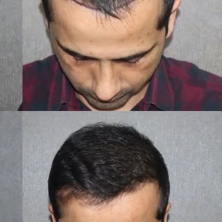 Saç tökülməsini gizlətmək yox, həll yolunu düşünmək vaxtıdır.

Hər gün saç düzümü ilə seyrək bölgələ