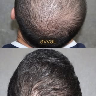 Təbii görünüşün əsasını ön saç xətti müəyyənləşdirir. Həddindən artıq düz, çox aşağı və ya üz qurulu