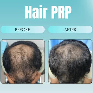 💆‍♀️✨ SAY GOODBYE TO HAIR FALL, HELLO TO HAIR GROWTH! ✨💆‍♂️
Struggling with thinning hair or hair 