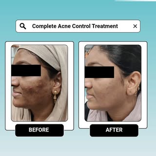 ✨ Clear skin isn't about hiding acne—it's about treating the root cause. ✨

Every transformation sta