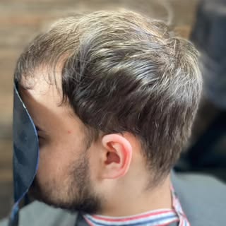 #hairunit #hairsystem #hairpeice #toupee  #hairlosssolutions #bald #nonsurgical #painfree #lookgoodf