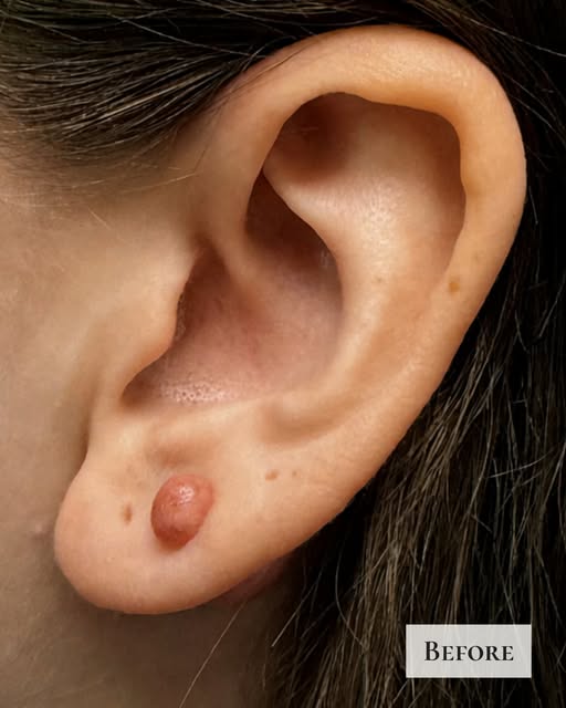 "Will this keloid just come back?" It's the first question I get from almost every patient with a ke