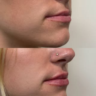 Evening out the ratio on these beautiful lips My patients give me the most amazing canvas’ to work w