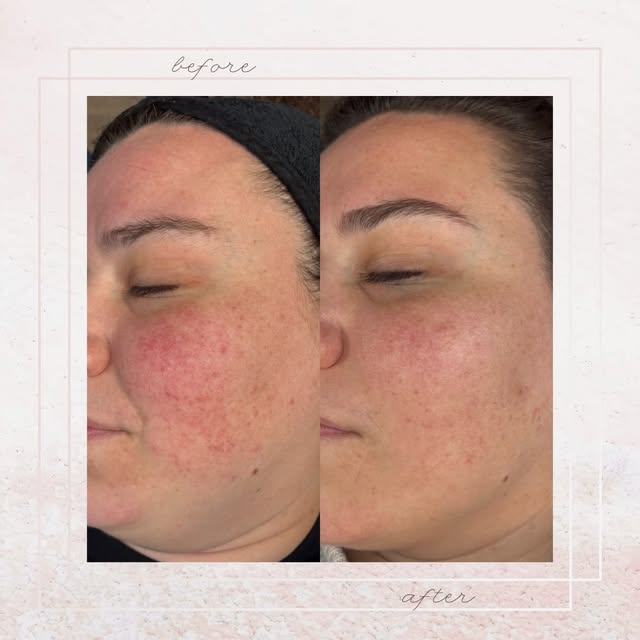 2 sessions excel-v laser ✨
.
.
.
.
#esthetics #aesthetics #dermatology #rosacea #laser